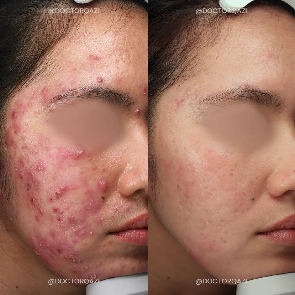 acne new1.webp