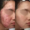 acne new1.webp