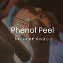 Phenol Peel with Dermabrasion