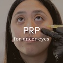 PRP Therapy for Undereye Dark Circles