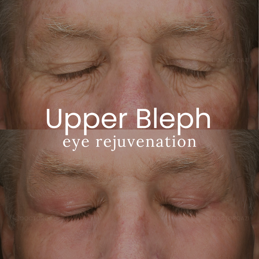 Upper Blepharoplasty Eyelid Treatment Without General Anesthesia