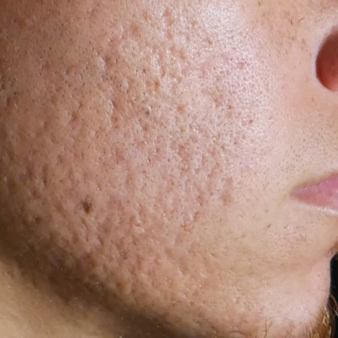 Acne Scars