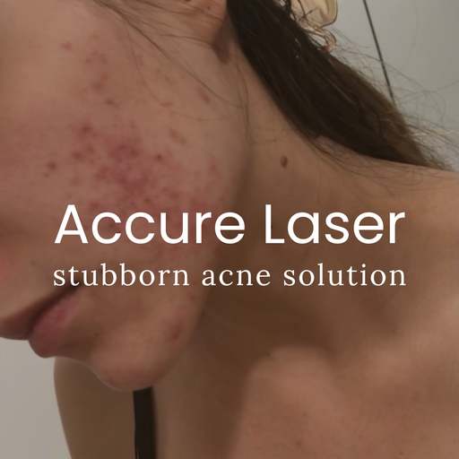 Accure Acne Laser Treatment (Student Discount)